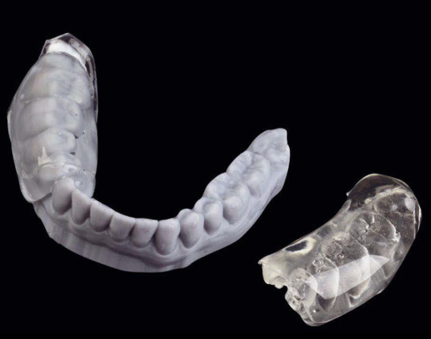 Restoring Teeth In The Posterior Region: Flowable Injection and Stamp Technique 